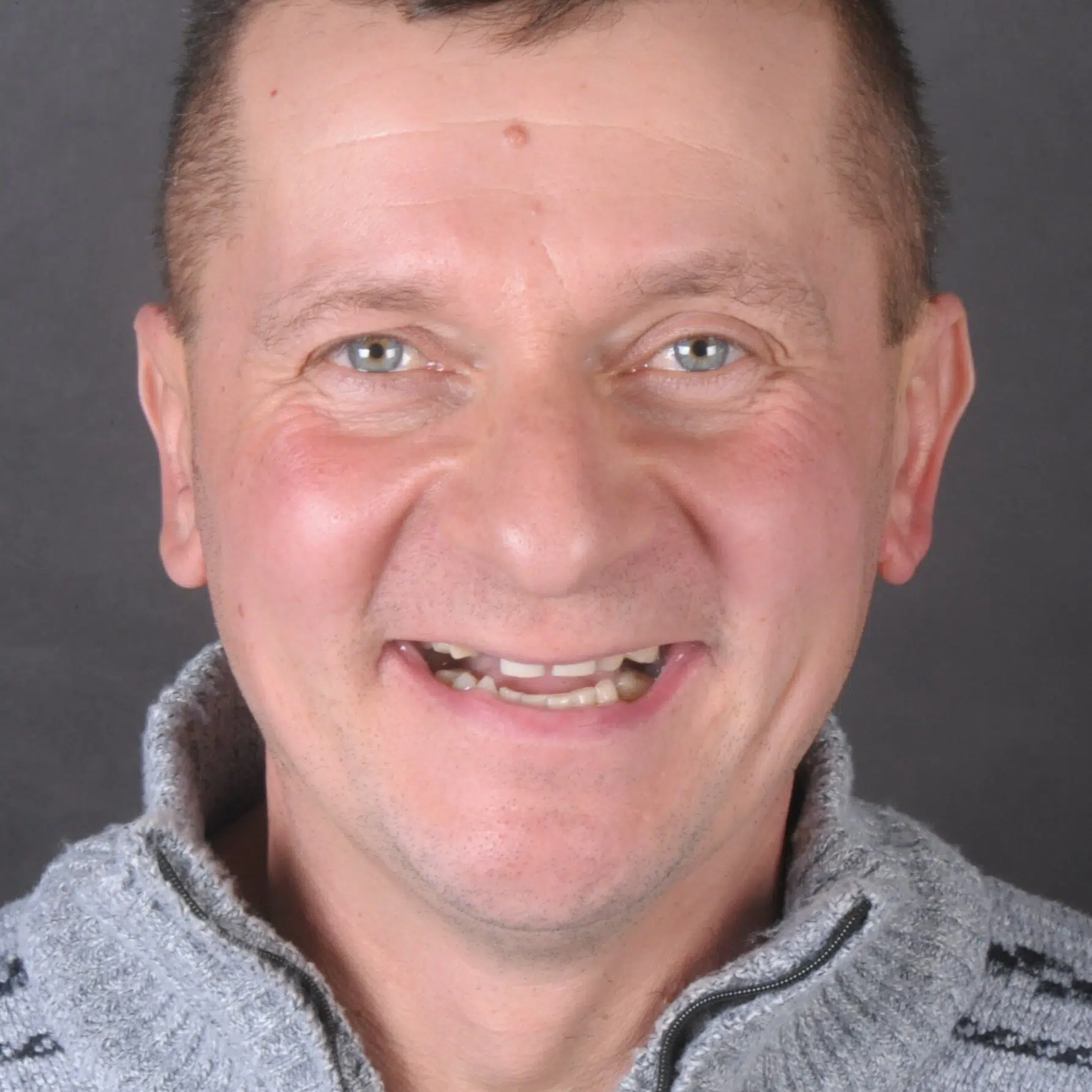 Odzyskaj uśmiech – Protokół Time For Implants™ 38 Wyzwanie 2