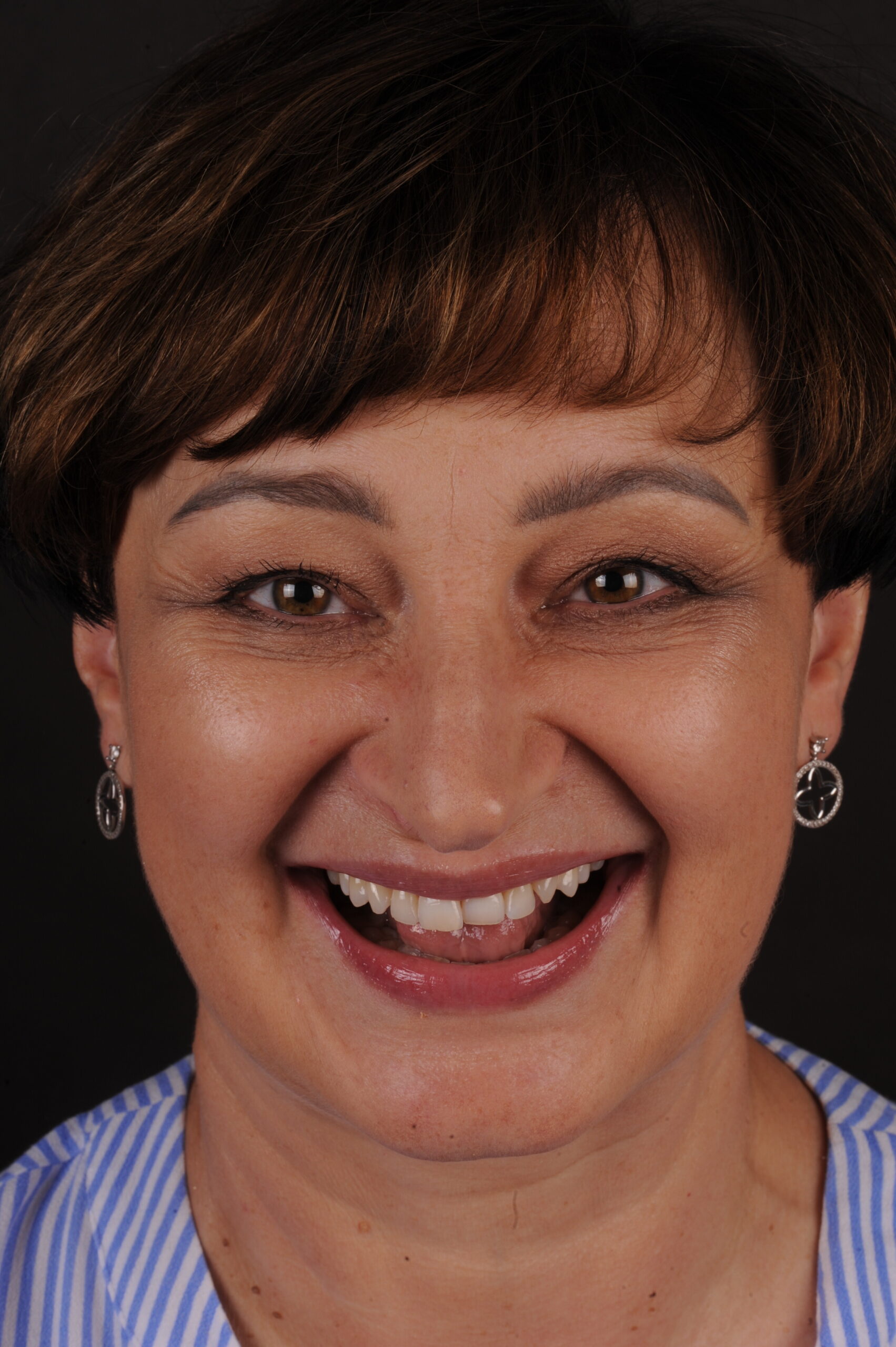 Metamorfoza uśmiechu pani Lucyny dzięki Invisalign i Flow Injection 3 Pani Lucyna przed terapią